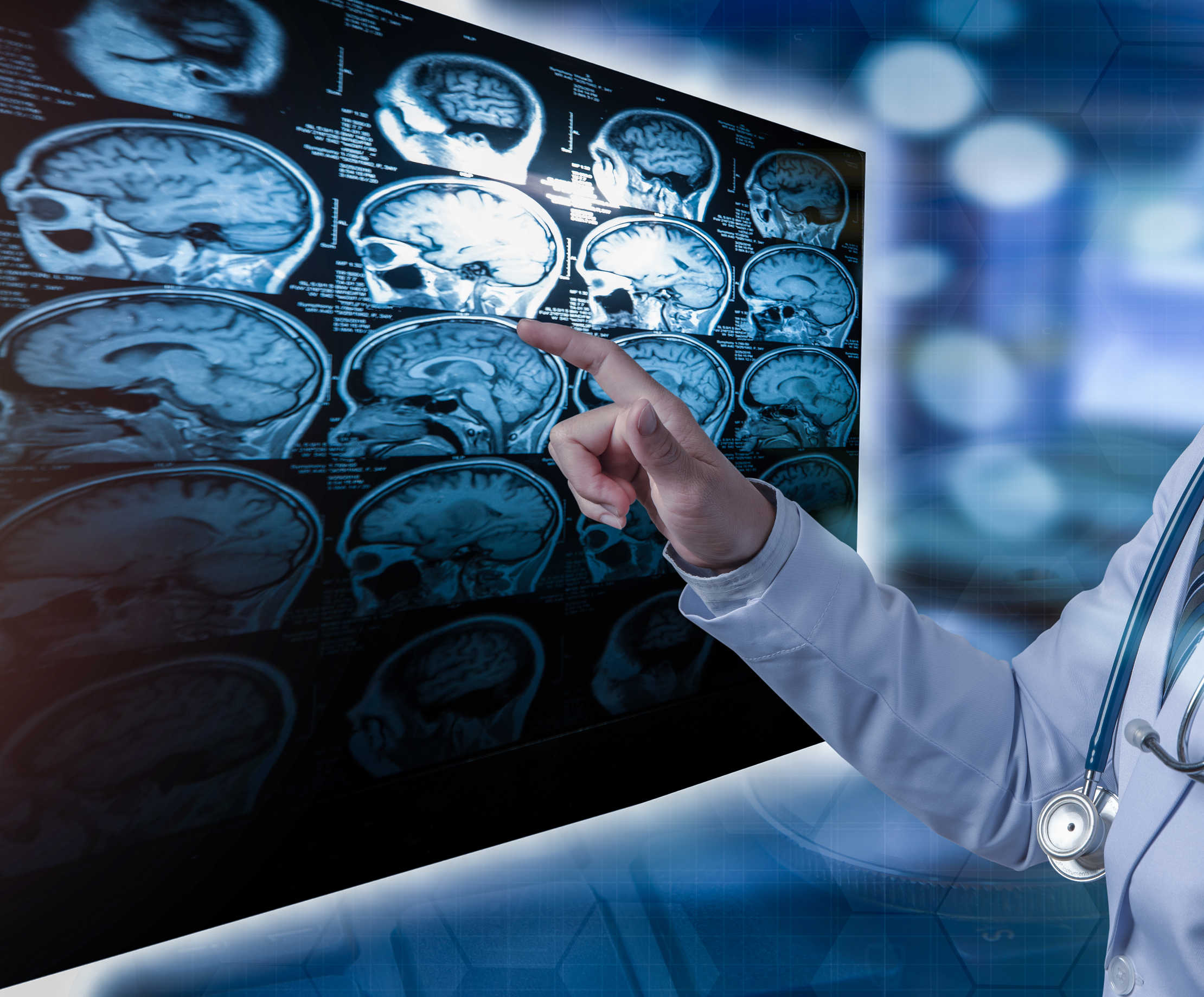 Ali diagnoza CIS/RIS pomeni, da gre za MS?