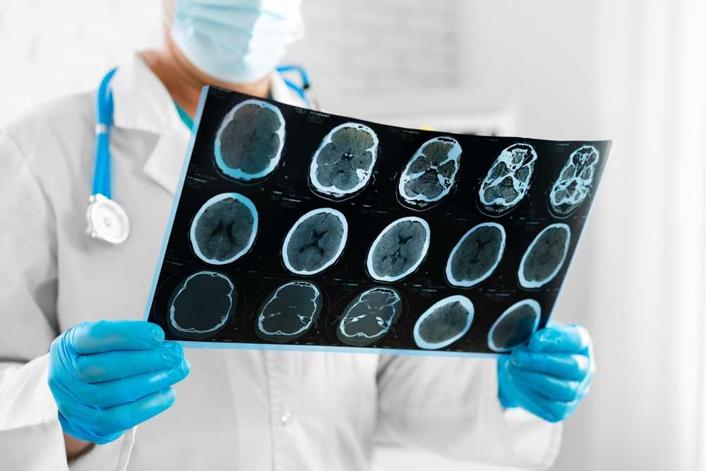 Kaj je radiološko izoliran sindrom - RIS?