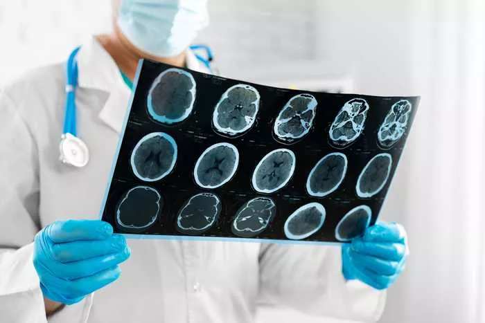 Kaj je radiološko izoliran sindrom - RIS?